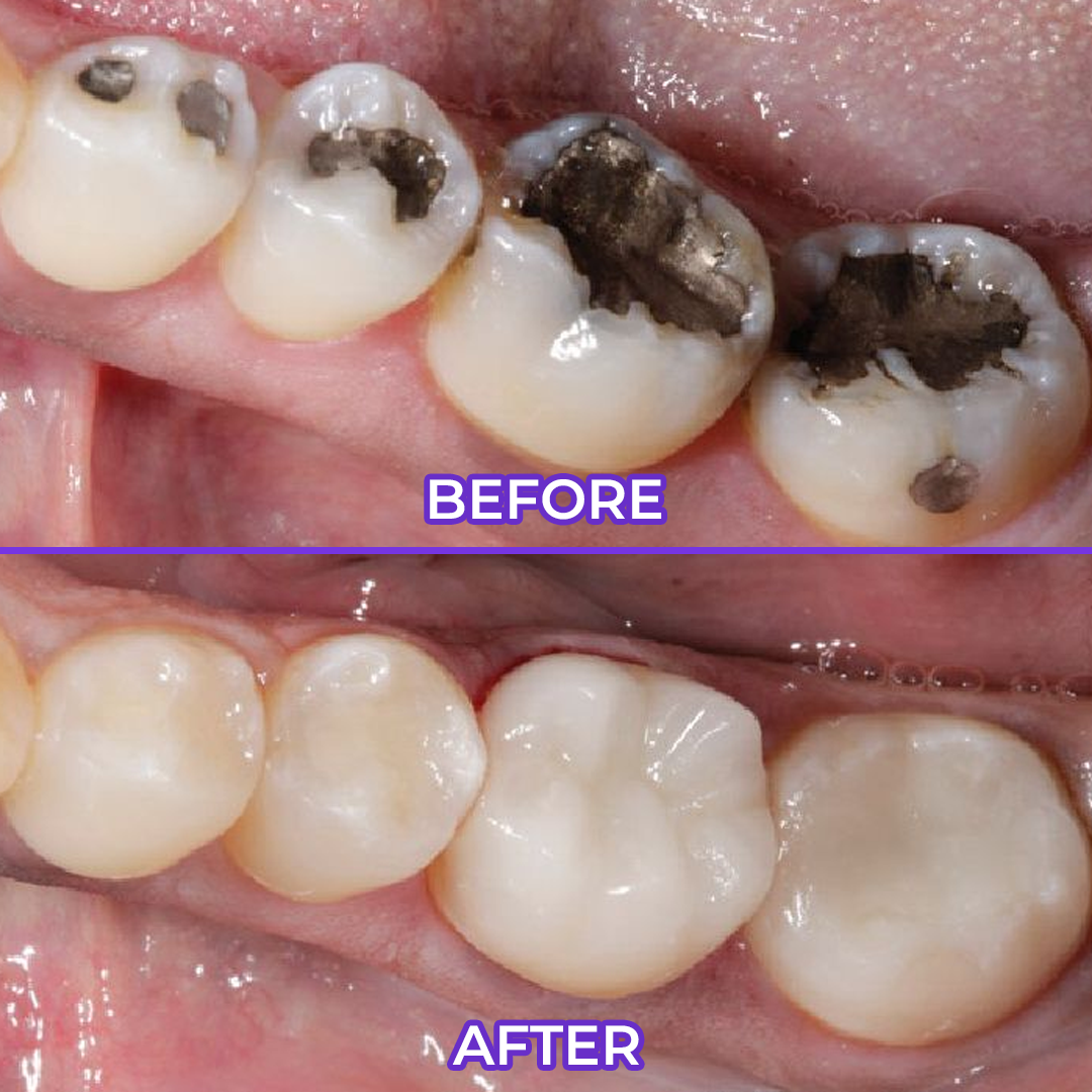 Fluoride Toothpaste