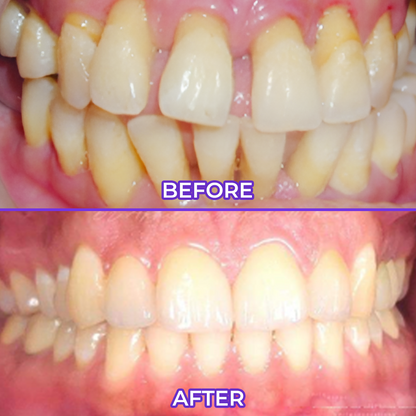 Fluoride Toothpaste