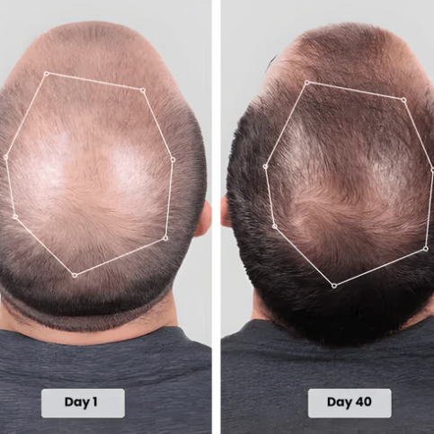 🔥HOT SALE 49% OFF🔥Red light hair growth CAP