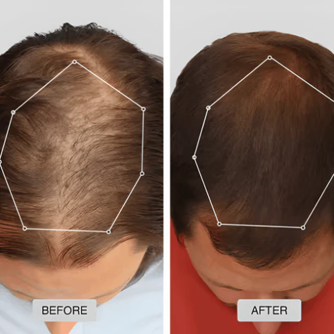 🔥HOT SALE 49% OFF🔥Red light hair growth CAP