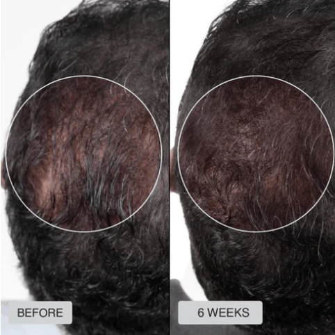🔥HOT SALE 49% OFF🔥Red light hair growth CAP